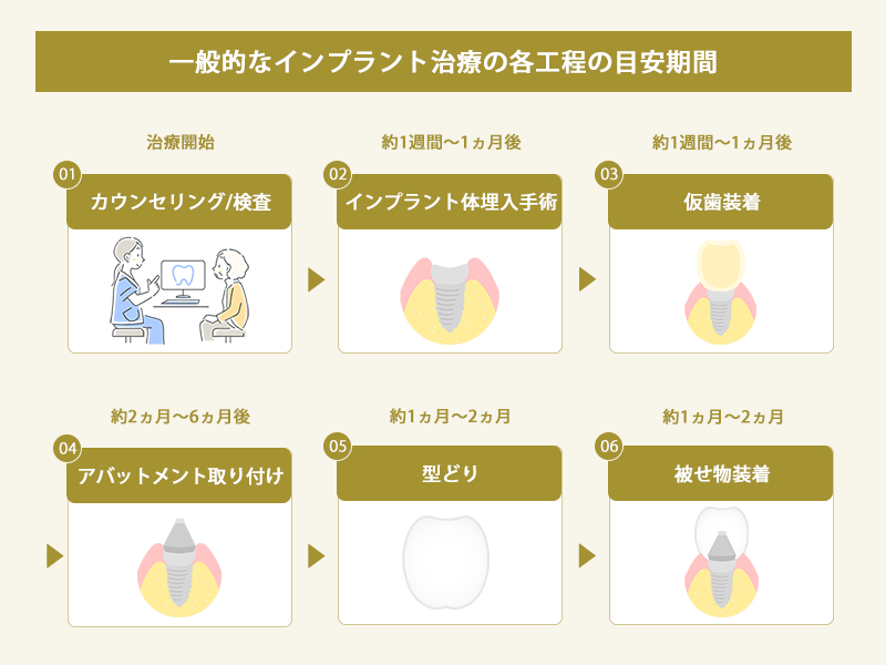 インプラントの治療工程と目安期間