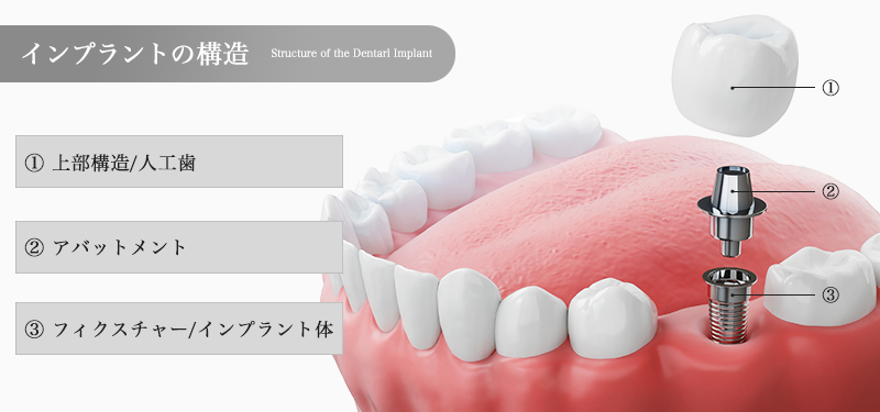 インプラントの構造・各パーツ名