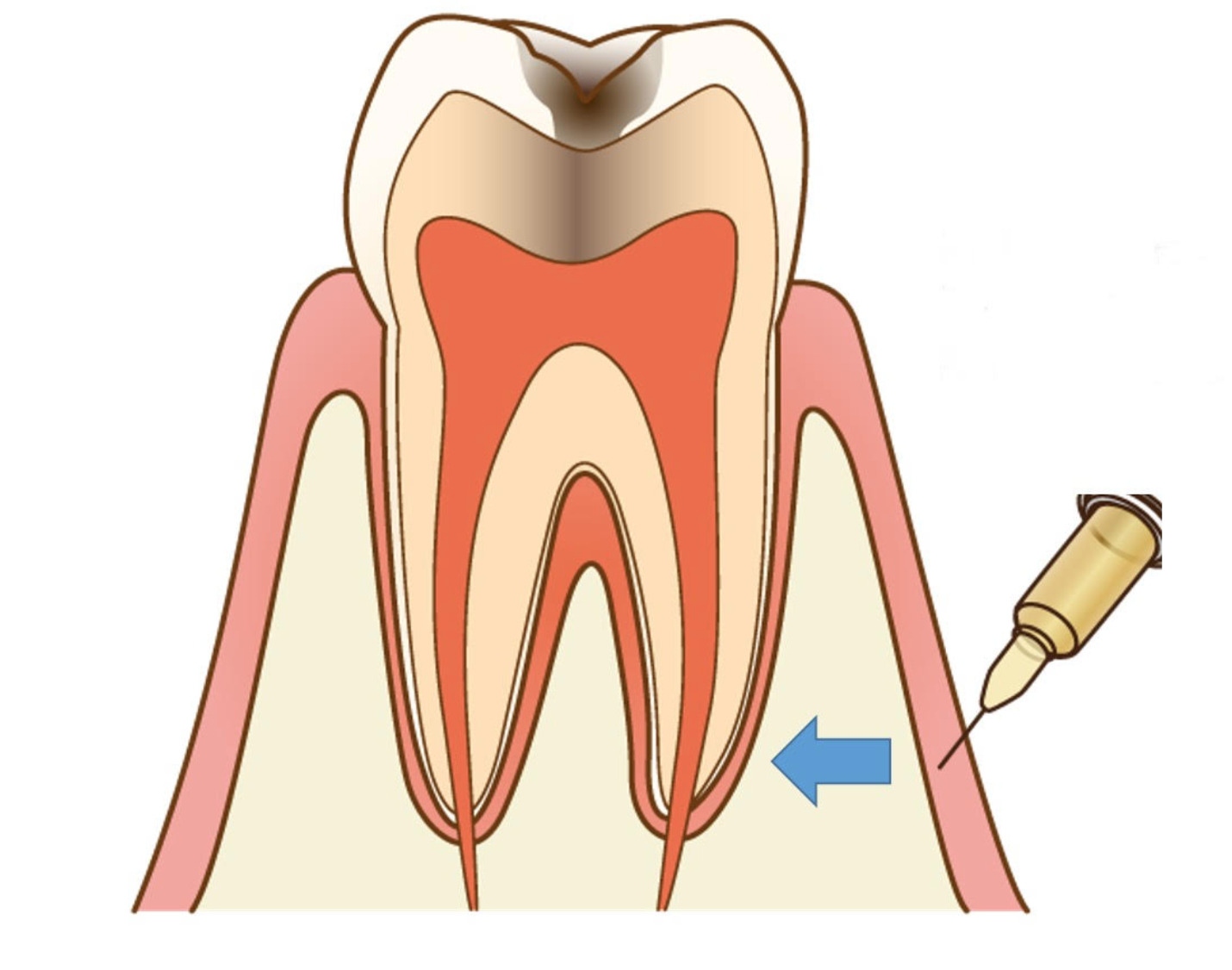 歯科麻酔が効かない･効きにくい時について 画像